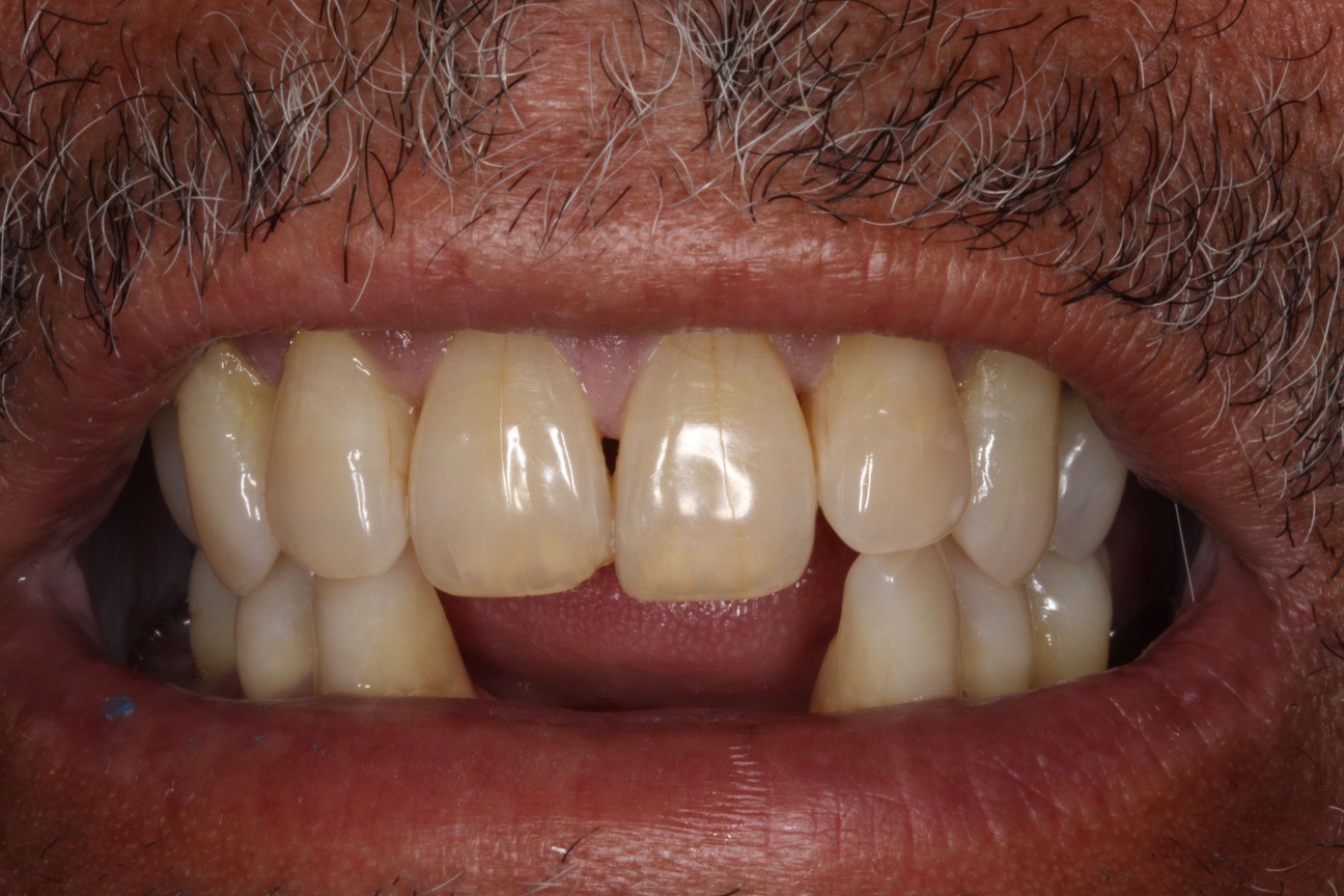 dentures_before